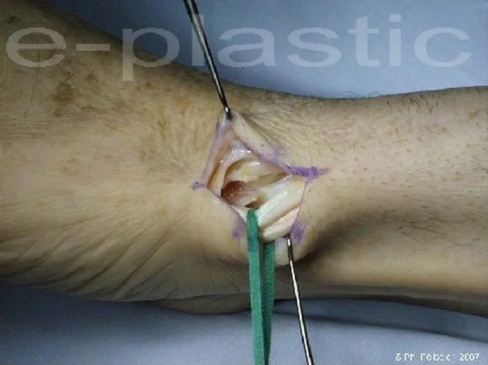 Ténosynovite de de Quervain — figure 4